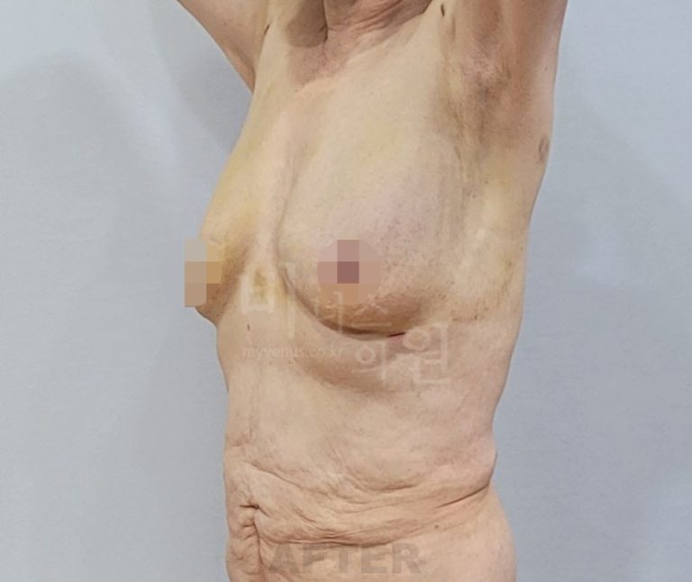 유방하수 지방흡입 비용, 왜 사람마다 다를까 — 상담에서 확인해야 할 3가지 기준