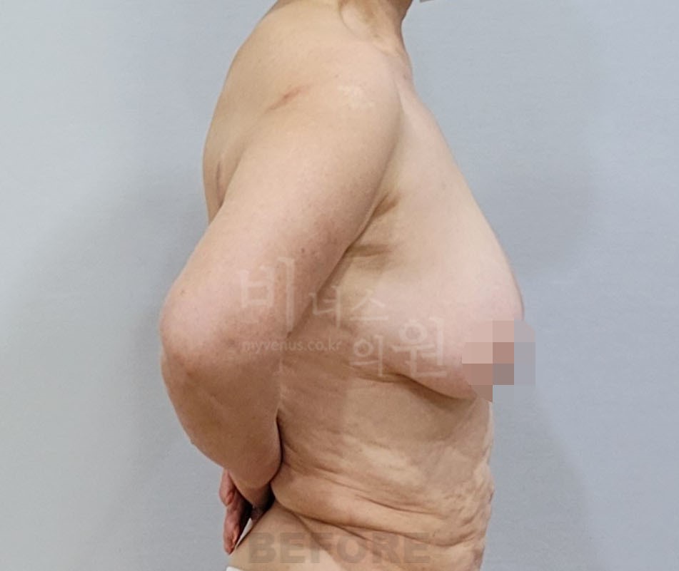 유방하수 지방흡입 수술 전 측면