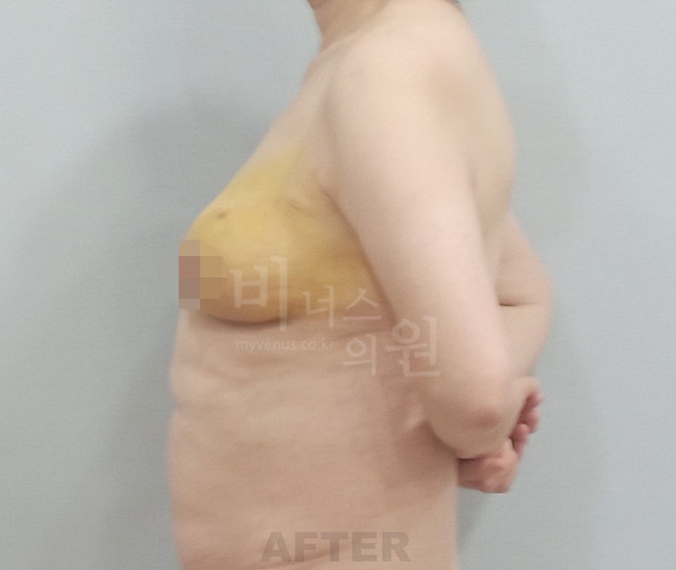 유방처짐 지방흡입 측면 수술 후