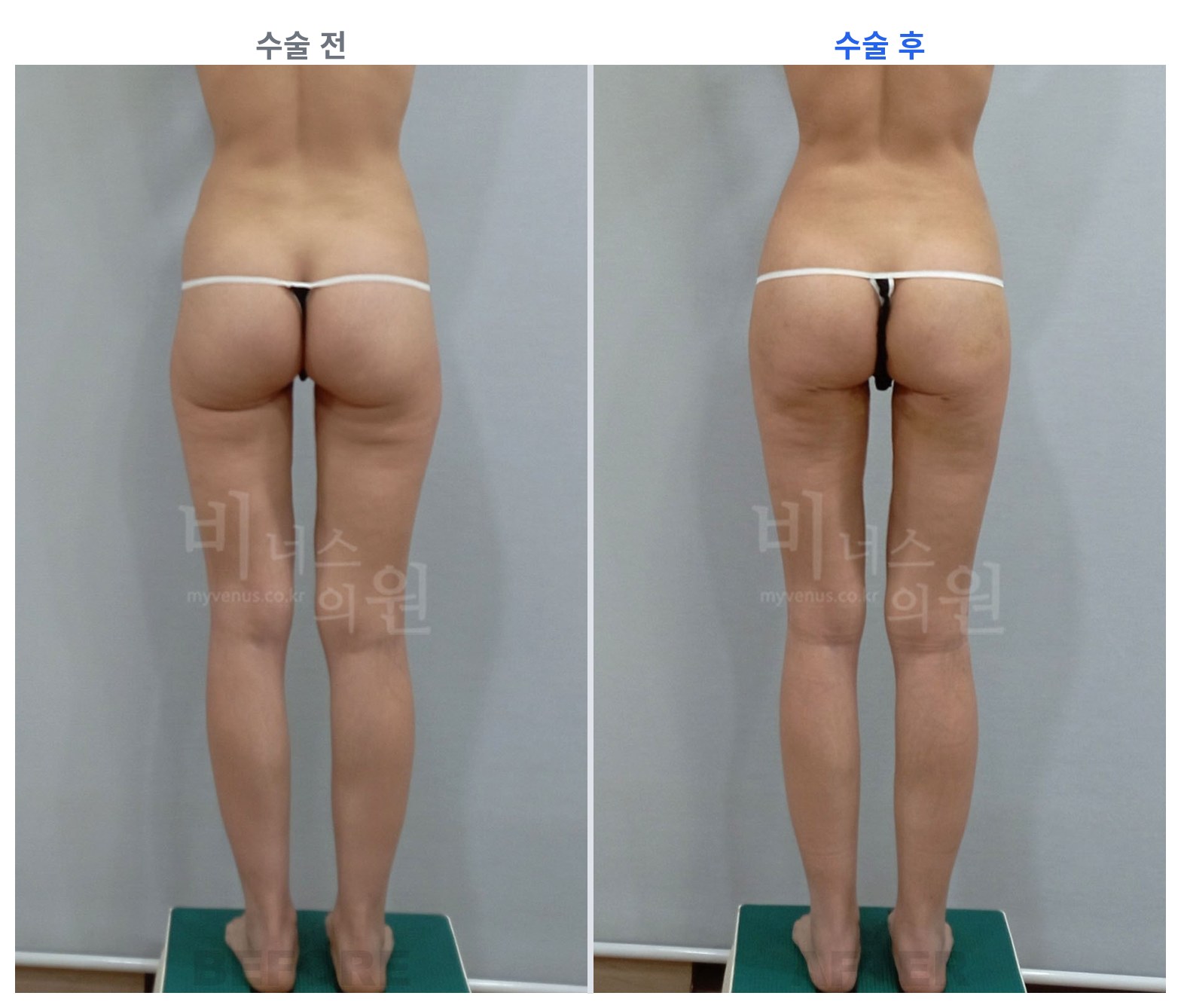엉덩이축소 지방흡입 후면 전후 비교 왼쪽 수술 전 오른쪽 수술 후