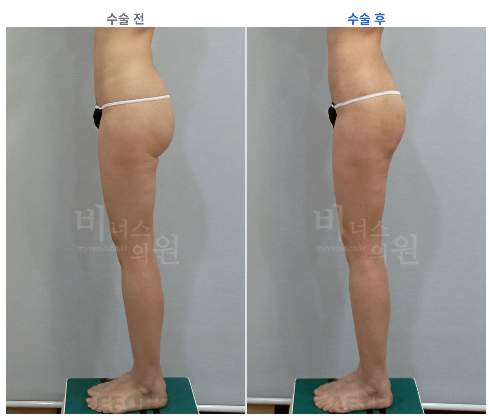 엉덩이축소 지방흡입 측면 전후 비교 왼쪽 수술 전 오른쪽 수술 후