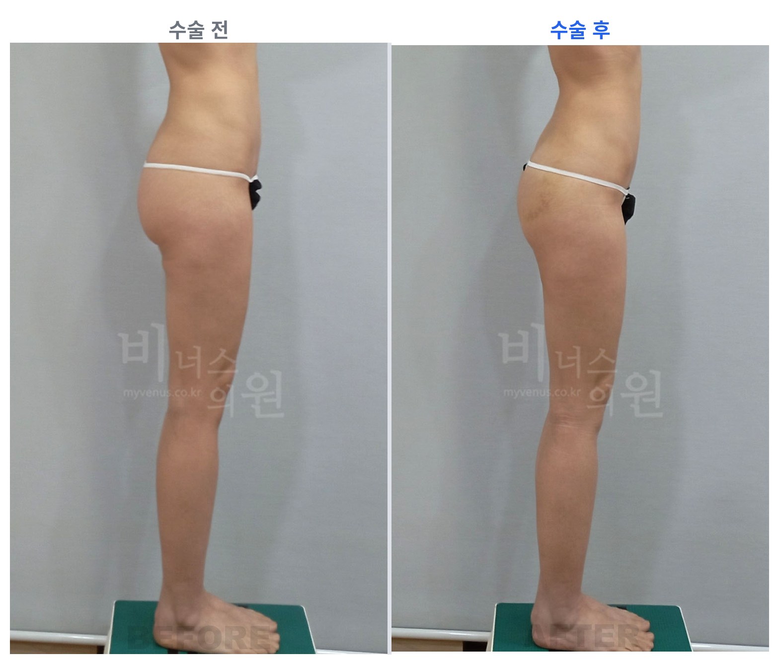엉덩이축소 지방흡입 반대쪽 측면 전후 비교 왼쪽 수술 전 오른쪽 수술 후