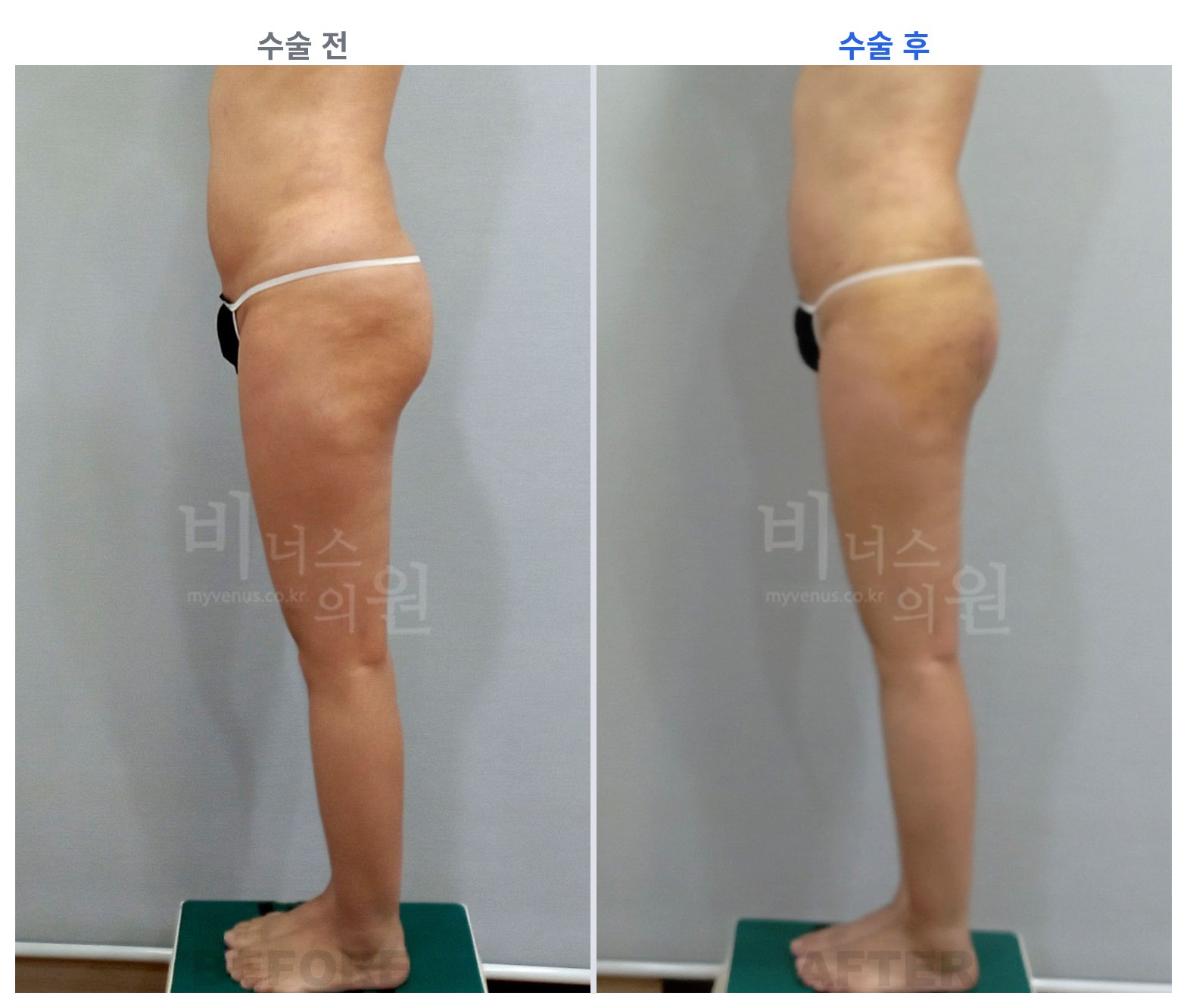 엉덩이축소 지방흡입 측면 전후 비교 왼쪽 수술 전 오른쪽 수술 후