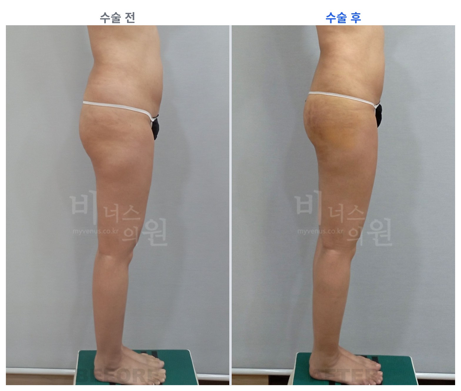 엉덩이축소 지방흡입 반대쪽 측면 전후 비교 왼쪽 수술 전 오른쪽 수술 후