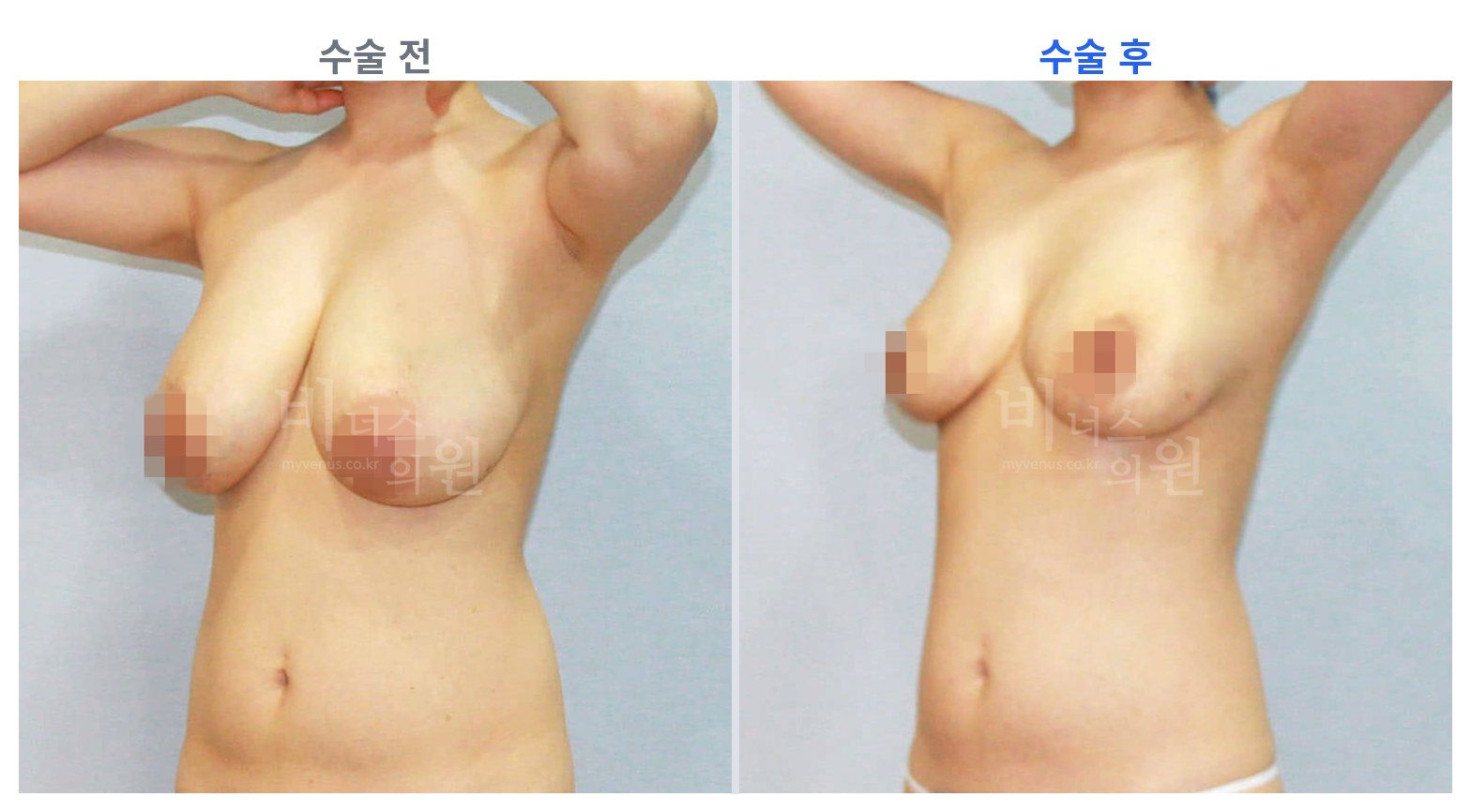유방하수 표층 지방흡입 45도 전후 비교 왼쪽 수술 전 오른쪽 수술 후