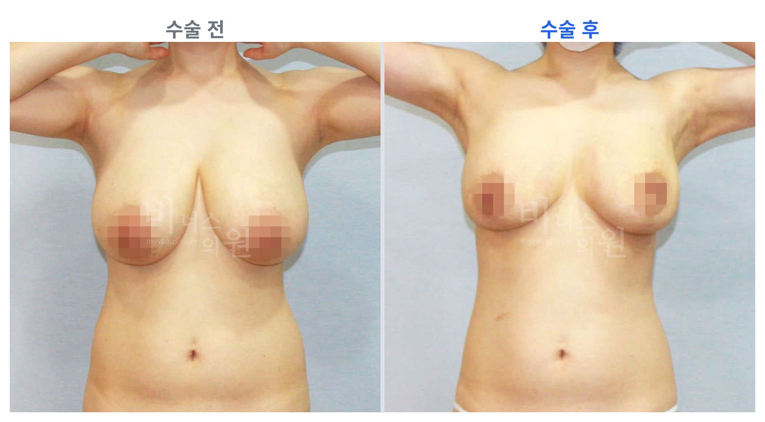 유방하수 표층 지방흡입 정면 전후 비교 왼쪽 수술 전 오른쪽 수술 후