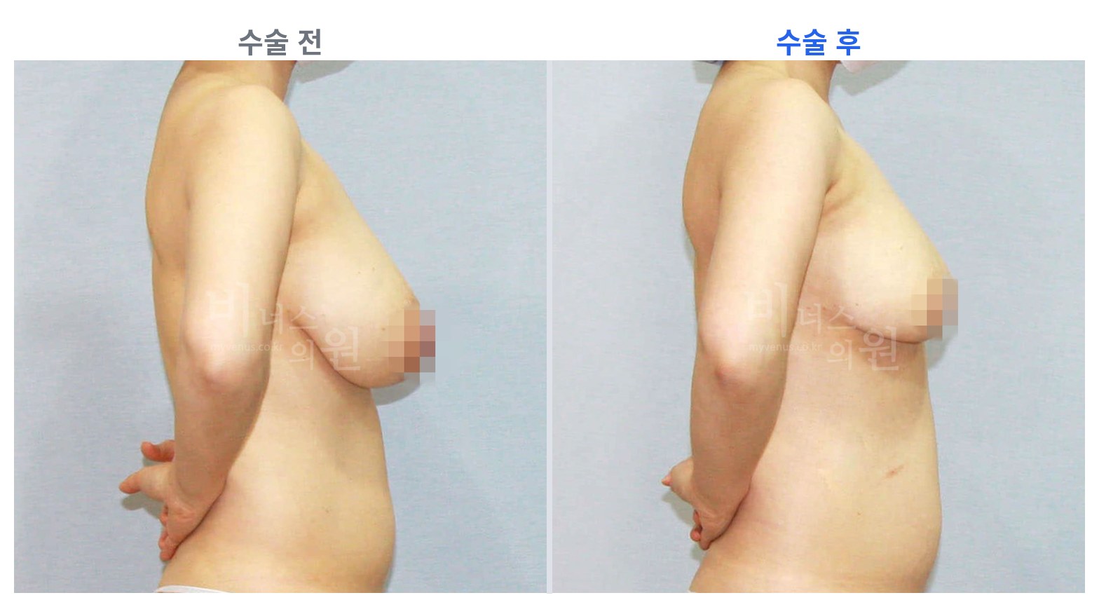 유방하수 표층 지방흡입 측면 전후 비교 왼쪽 수술 전 오른쪽 수술 후
