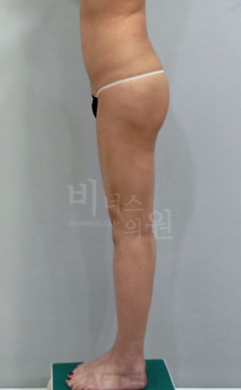 엉덩이 볼륨업 지방흡입 수술 후 측면 1