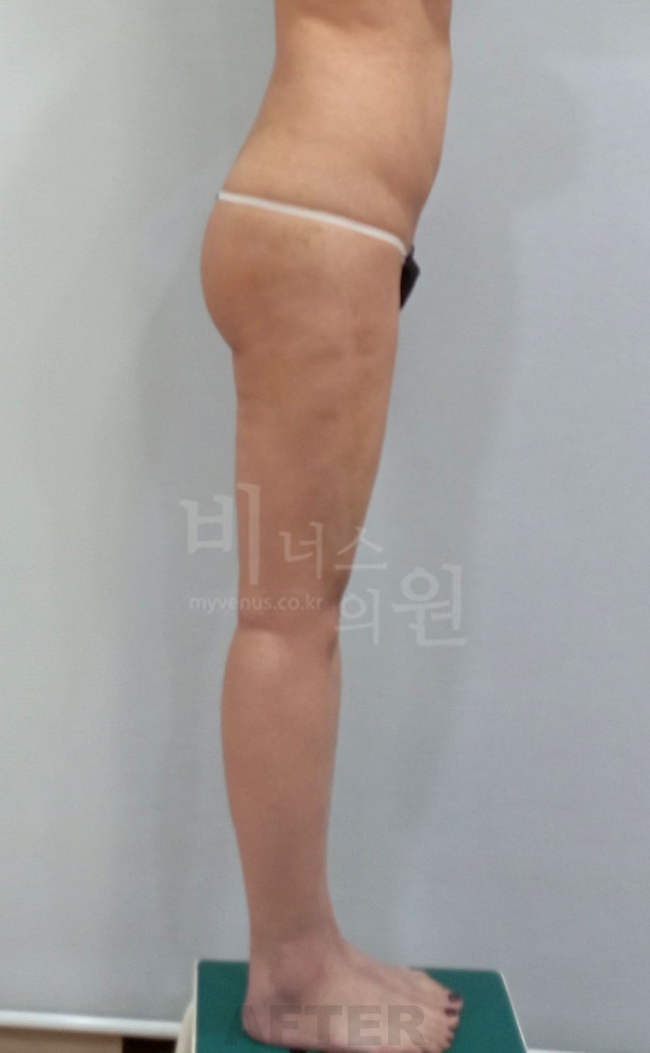 엉덩이 볼륨업 지방흡입 수술 후 측면 2