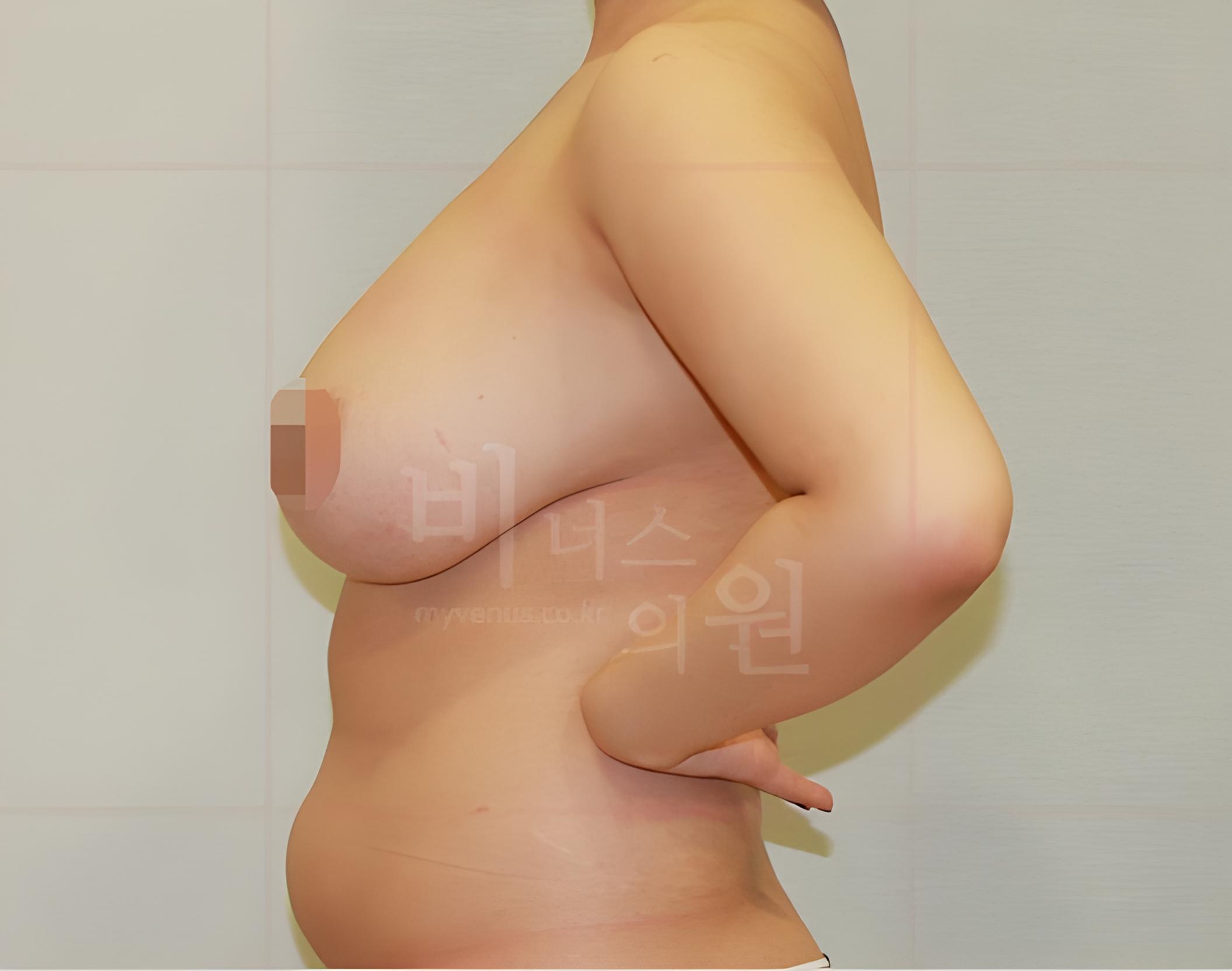 유방하수 지방흡입 수술 전 45도