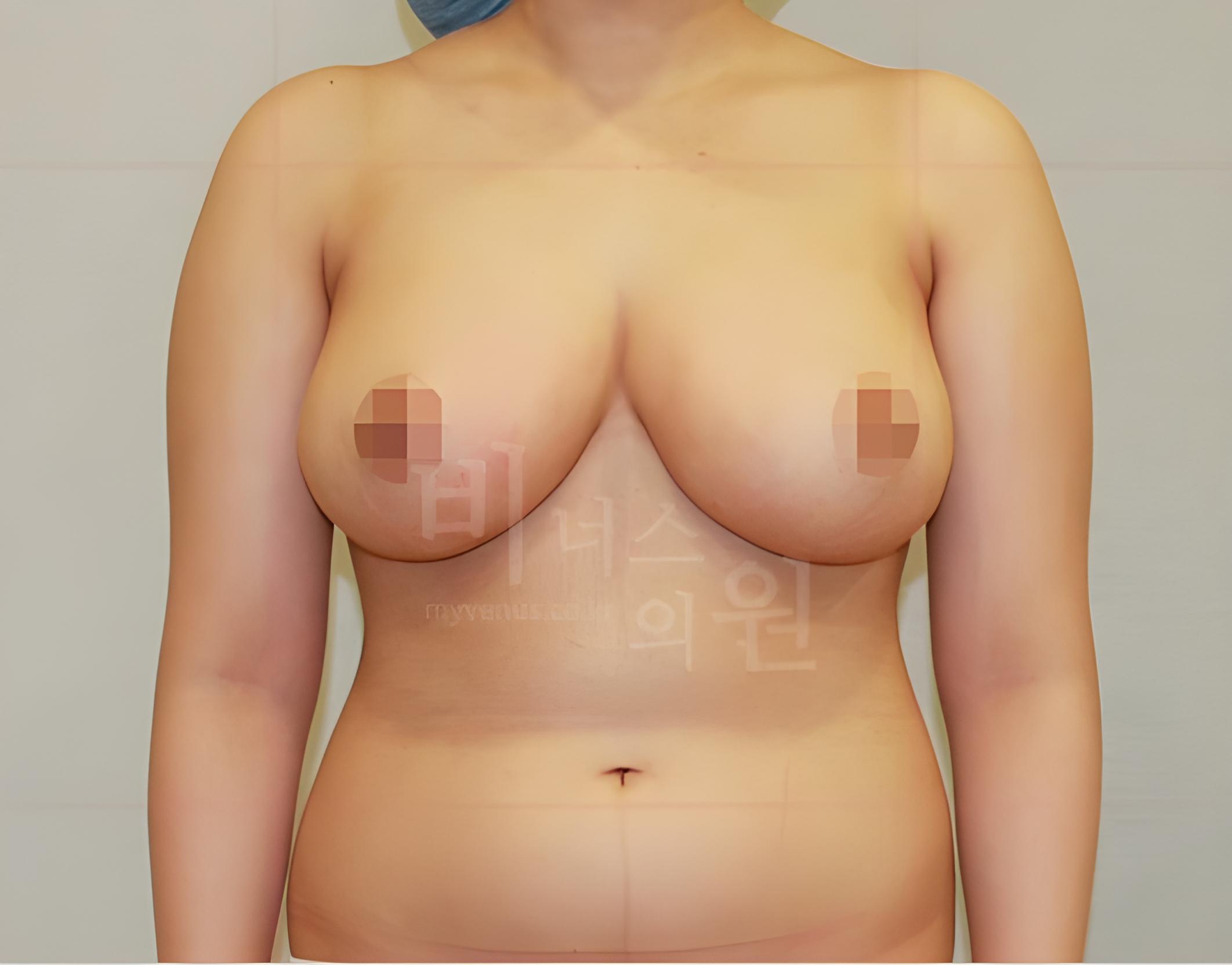유방하수 지방흡입 수술 후 정면