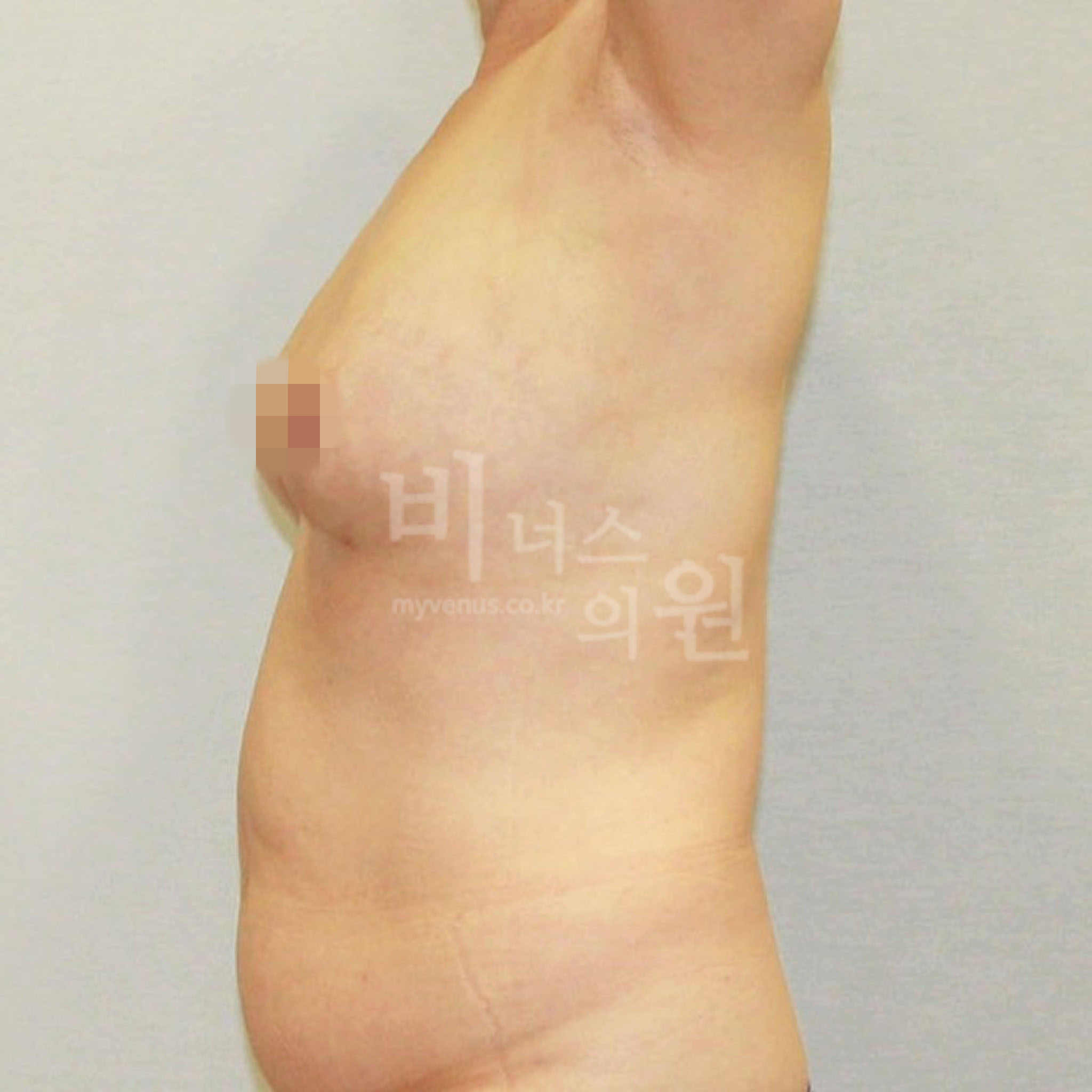 유방하수 지방흡입 수술 후 측면