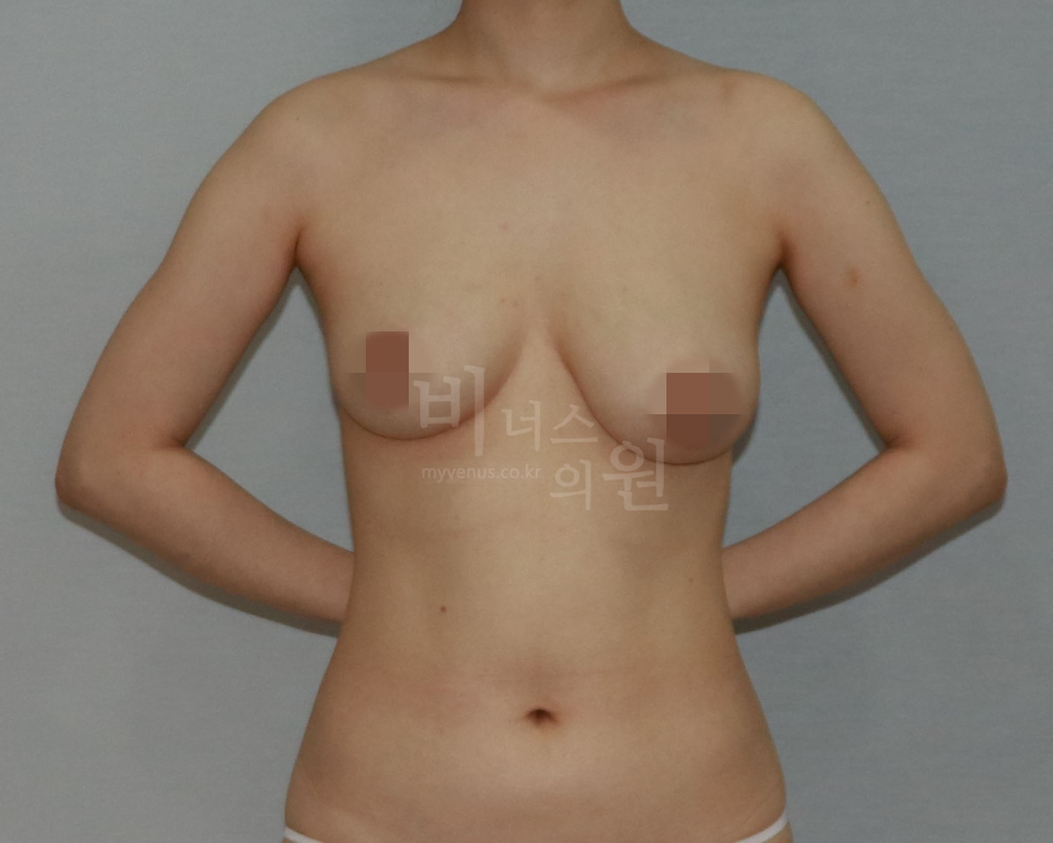 유방축소 지방흡입 정면 수술 전