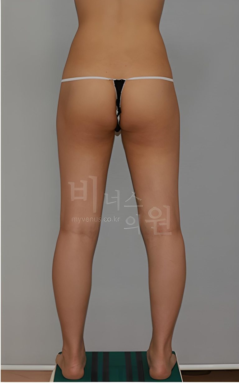 엉덩이축소, 다들 이렇게 알고 계셨나요? — 자주 묻는 질문 6가지로 바로잡는 오해