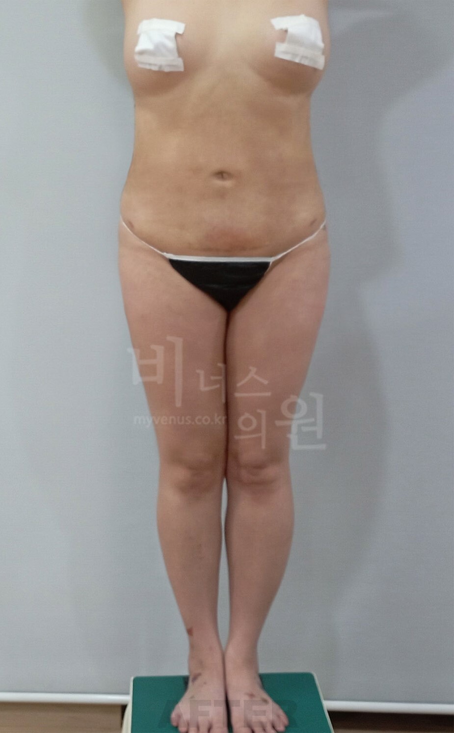 엉덩이축소 지방흡입 수술 후 정면