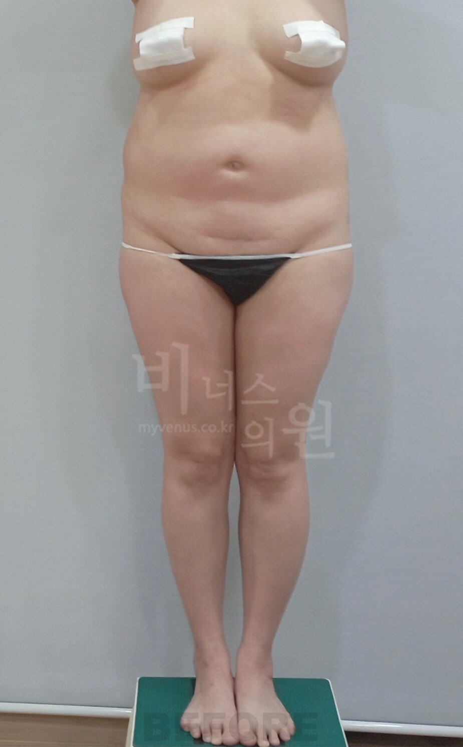 엉덩이축소 지방흡입 수술 전 정면