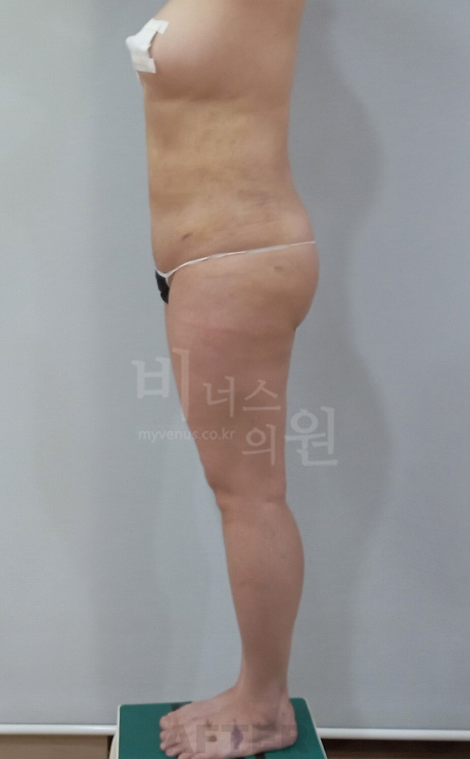 엉덩이축소 지방흡입 수술 후 좌측면