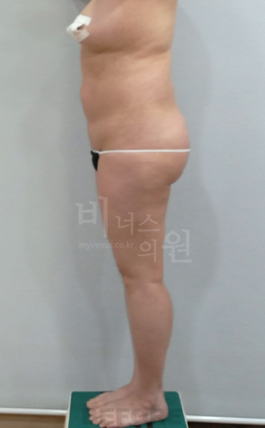 엉덩이축소 지방흡입 수술 전 좌측면