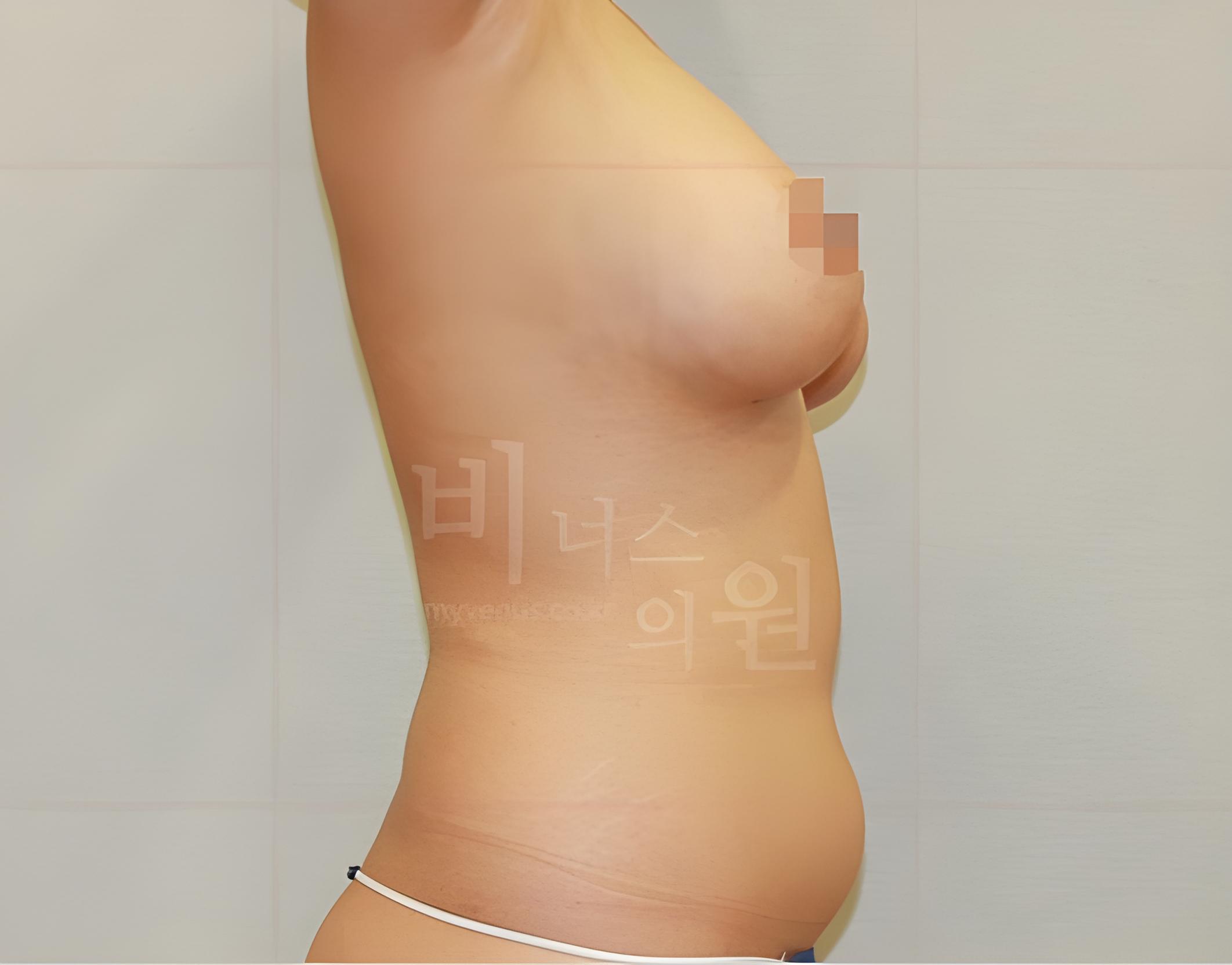 유방하수 지방흡입 수술 후 측면