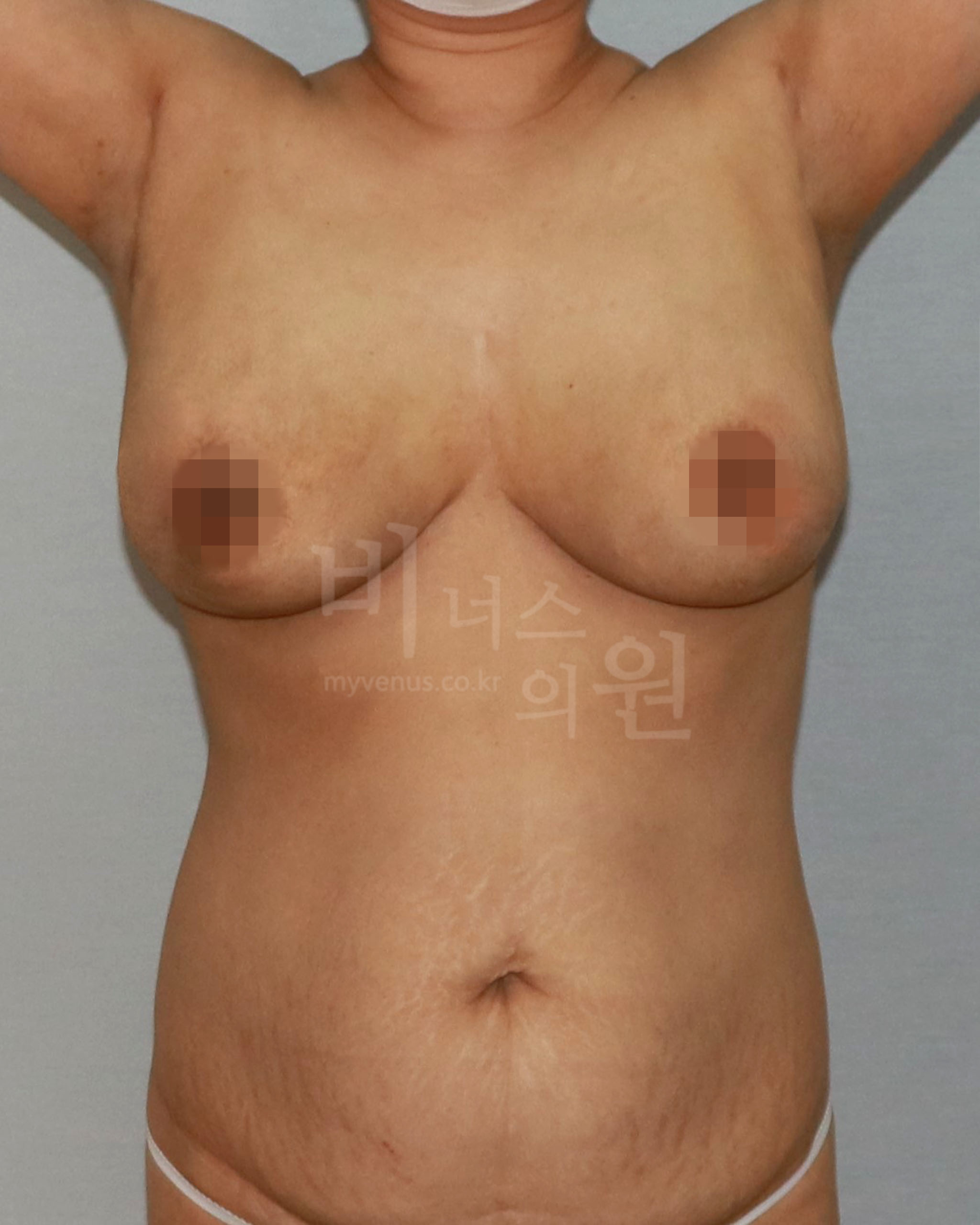 유방축소·가슴지방흡입 사례 사진 3 (2019년 촬영)
