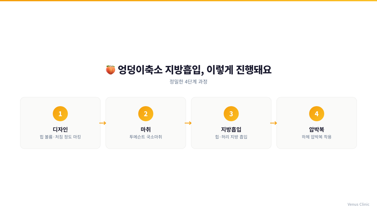 엉덩이축소 지방흡입 진행 단계 인포그래픽 — 디자인, 투메슨트 국소마취, 지방흡입, 압박복 착용 4단계