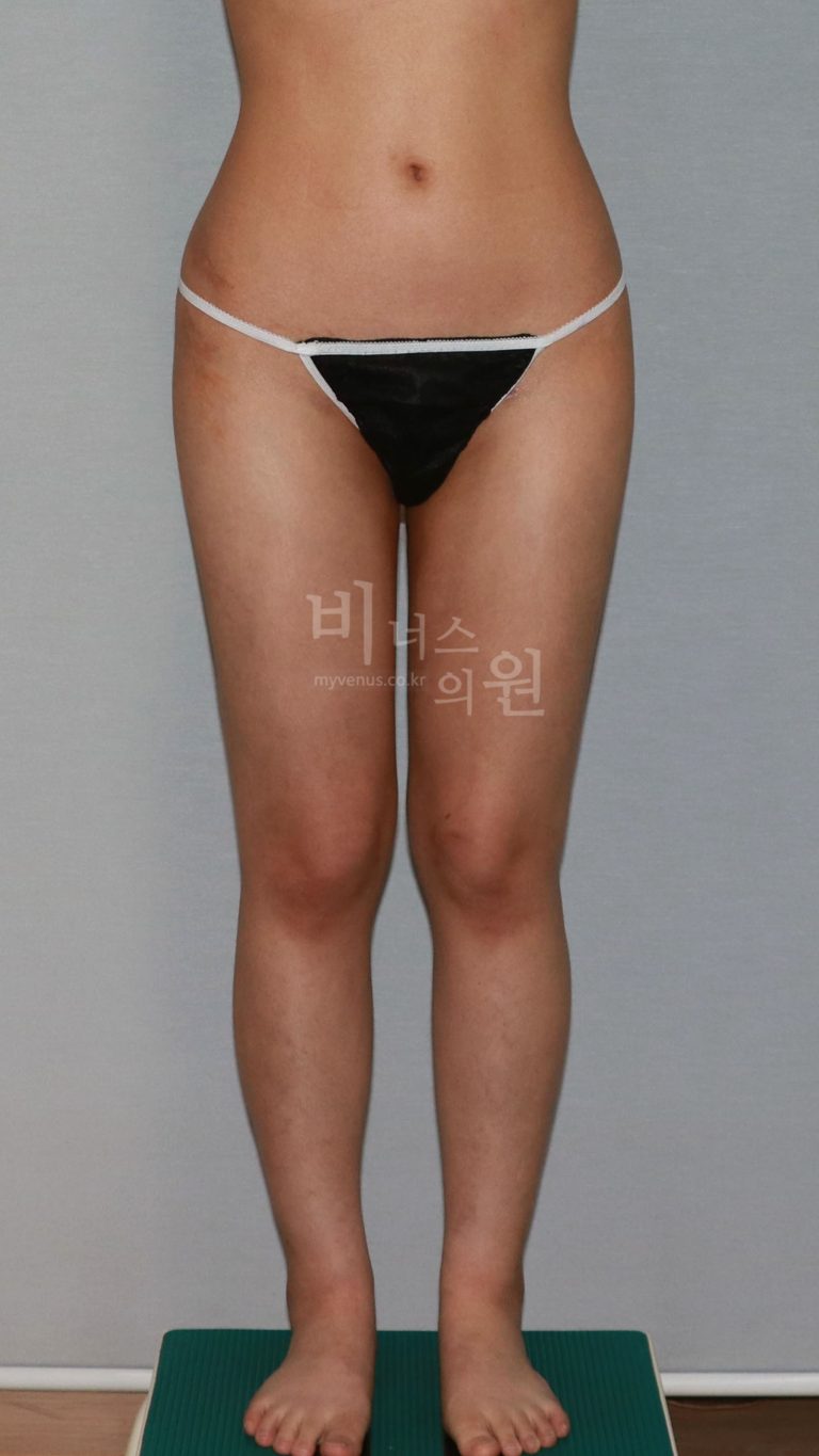 허벅지 지방흡입 수술 후 정면