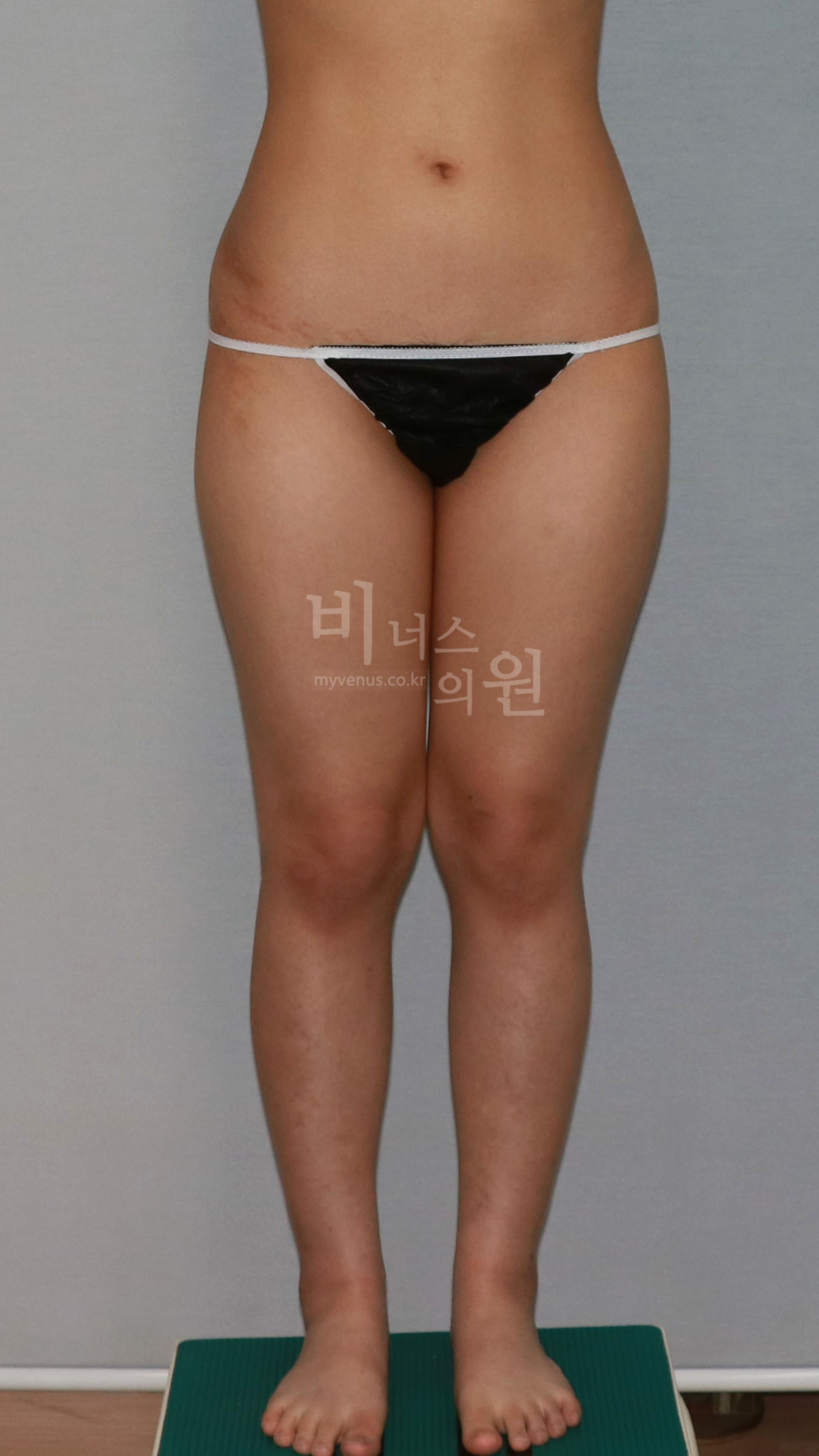 허벅지 지방흡입 수술 전 정면