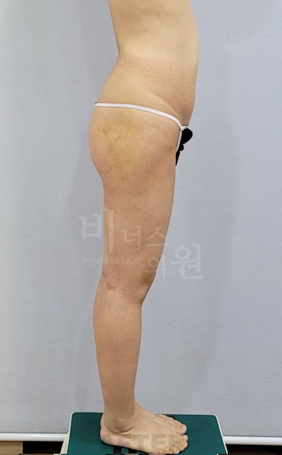엉덩이축소 지방흡입 수술 후 측면 반대쪽 사진