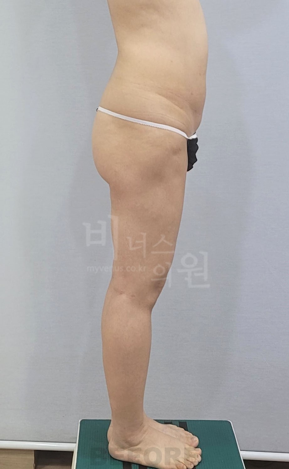 엉덩이축소 지방흡입 수술 전 측면 반대쪽 사진