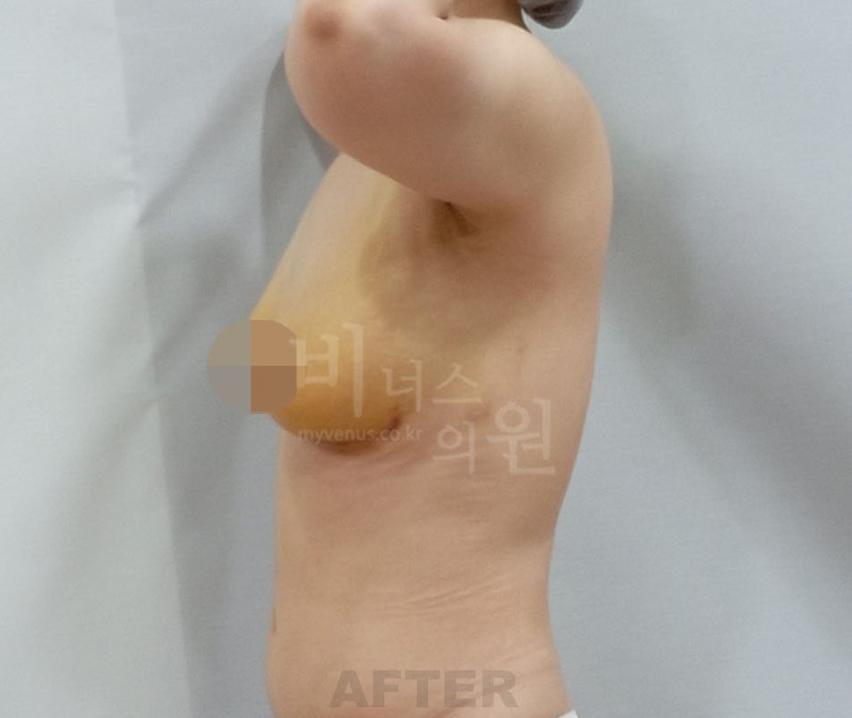 가슴축소 지방흡입 수술 후 1주일 측면 사진