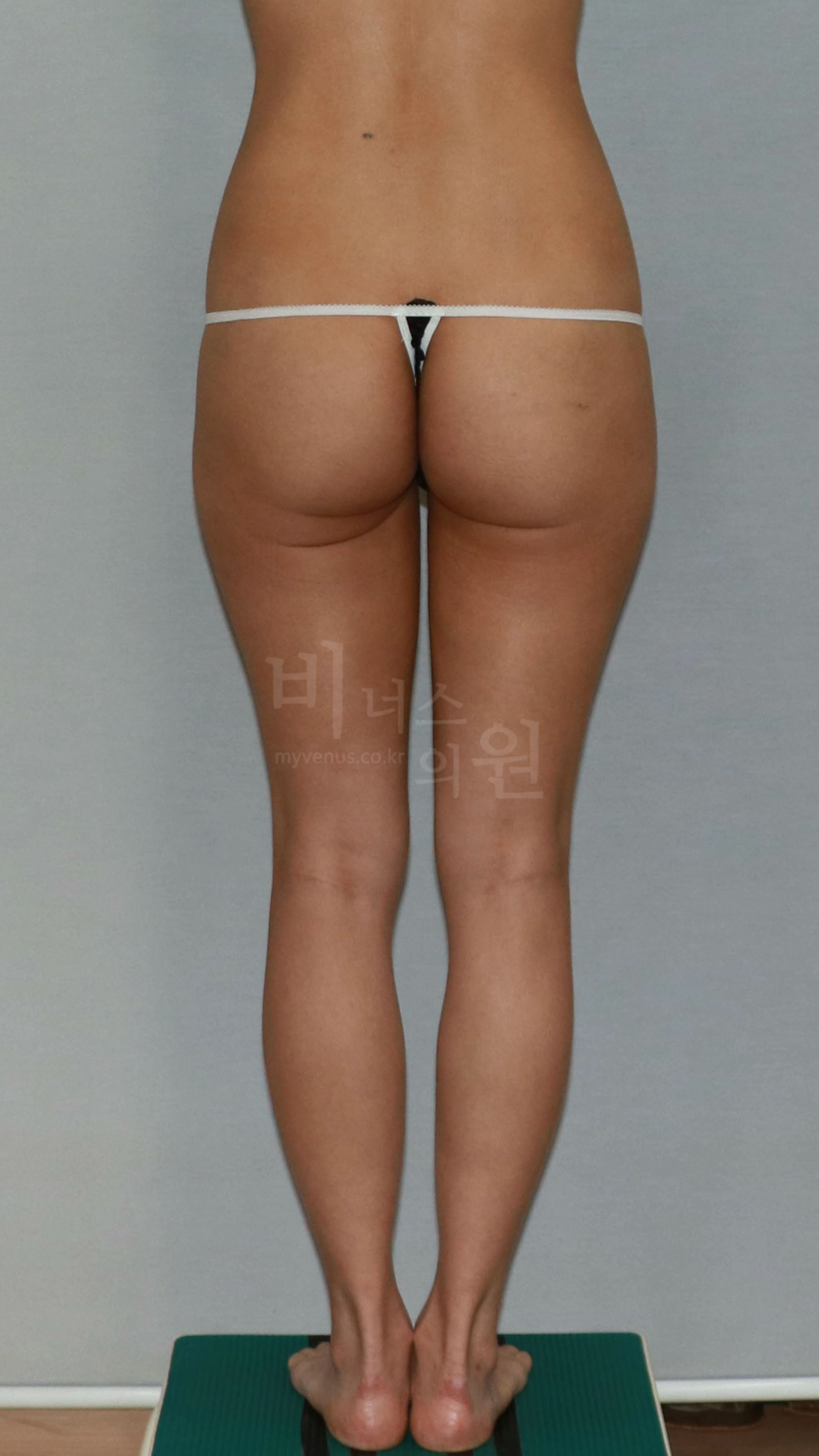 엉덩이 라인 수술 전 후면 비교 1 사진