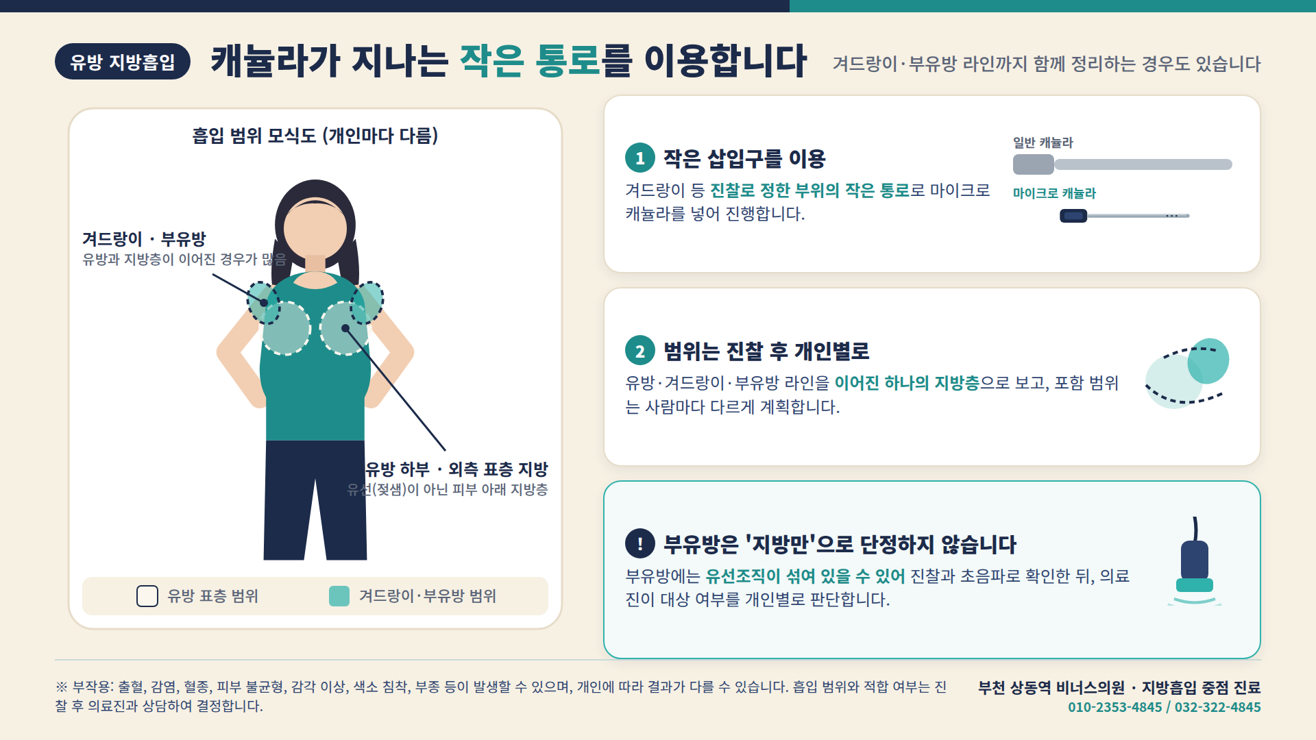 유방·겨드랑이·부유방 흡입 범위 모식도와 작은 삽입구 안내