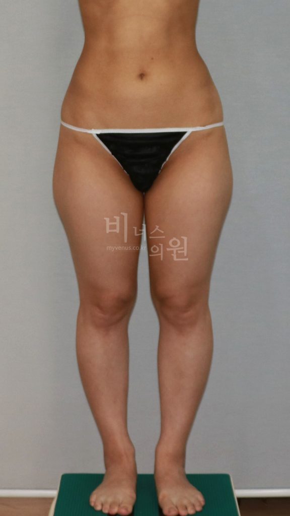 허벅지 지방흡입 수술 전 정면 비교 사진