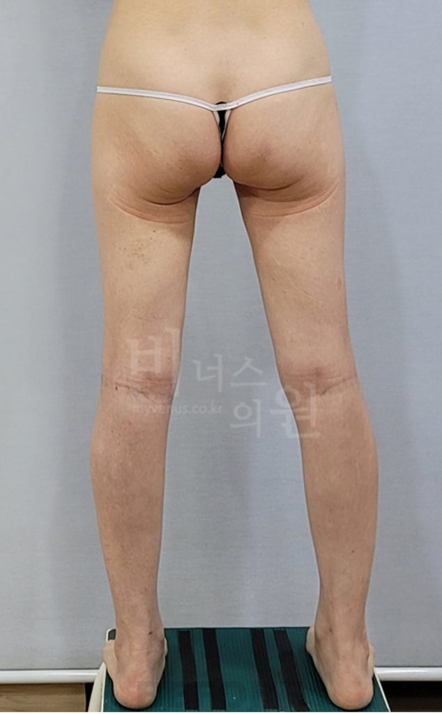 엉덩이축소 볼륨업 지방흡입 수술 전 후면 사진