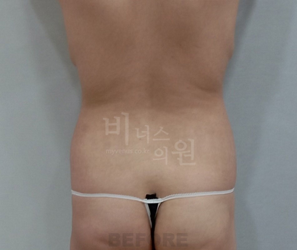 복부 지방흡입 수술 전 후면 사진