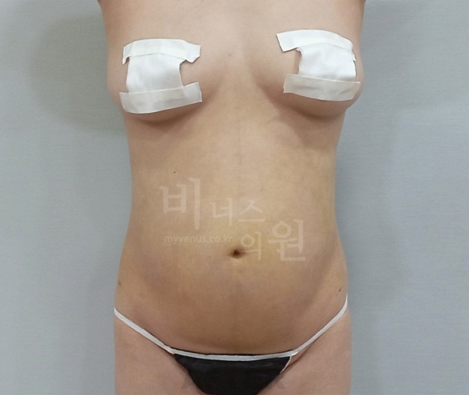 복부 지방흡입 수술 후 정면 사진