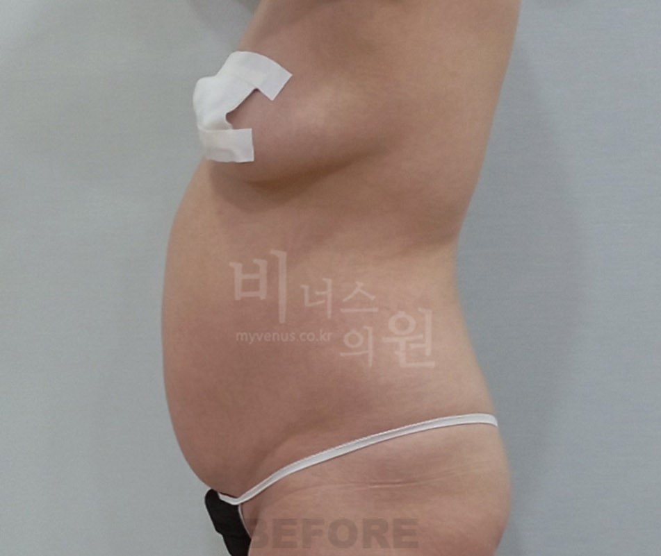 복부 지방흡입 수술 전 측면 사진