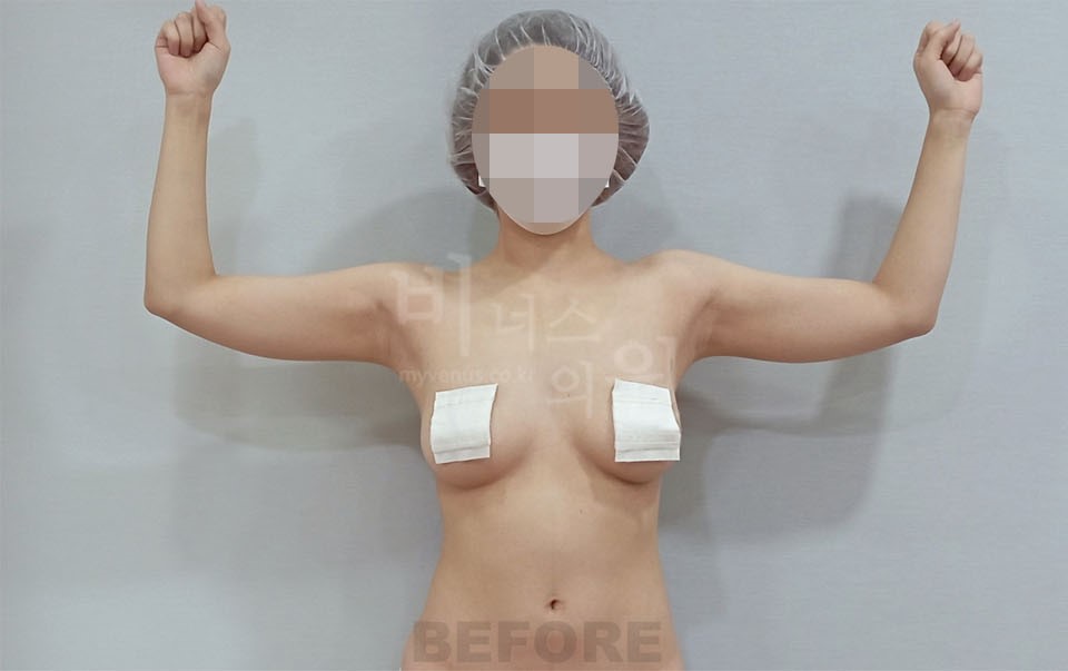 팔뚝지방흡입 정면 팔 굽혀 든 자세 수술 전