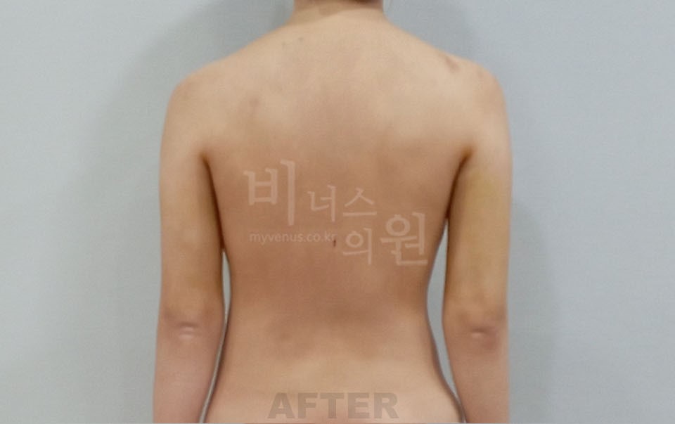팔뚝지방흡입 후면 차렷 수술 후