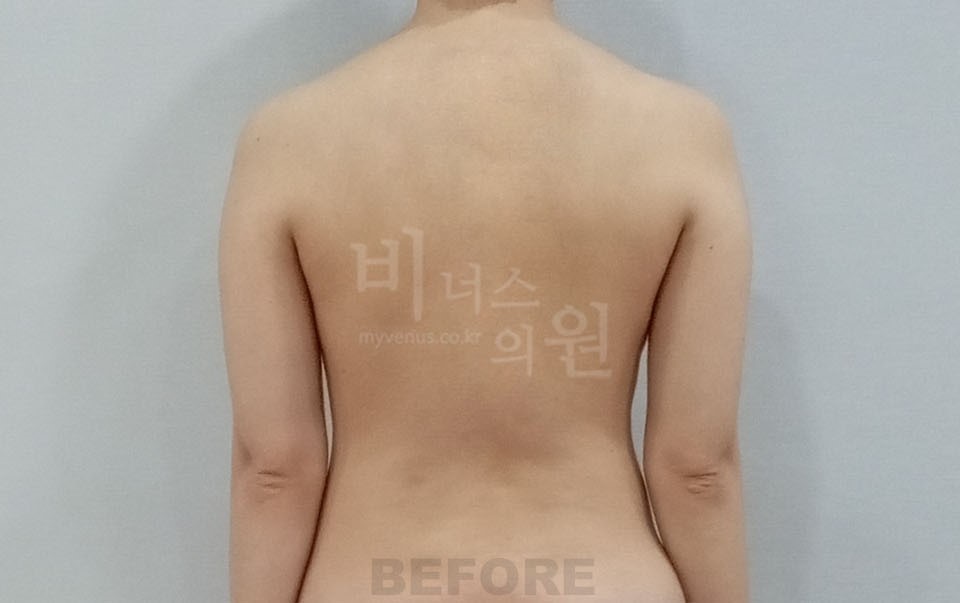 팔뚝지방흡입 후면 차렷 수술 전
