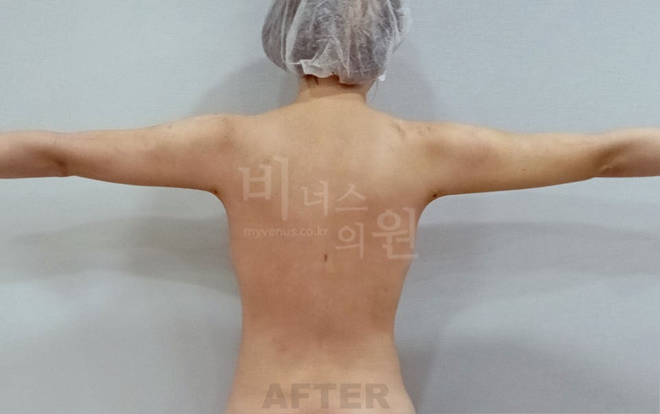 팔뚝지방흡입 후면 팔 벌린 자세 수술 후