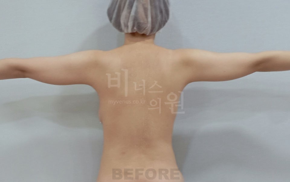 팔뚝지방흡입 후면 팔 벌린 자세 수술 전