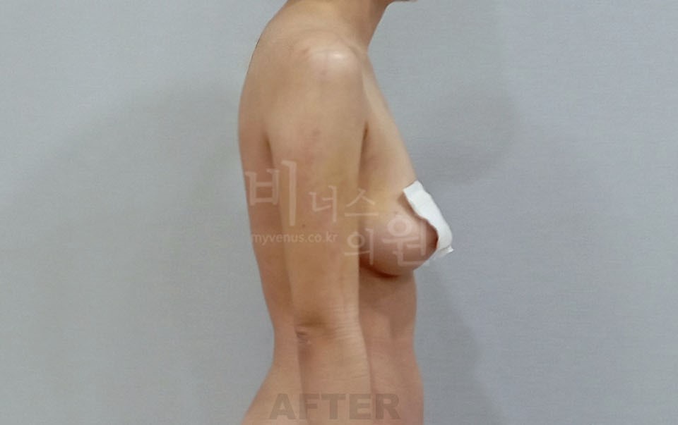 팔뚝지방흡입 측면 B 차렷 수술 후