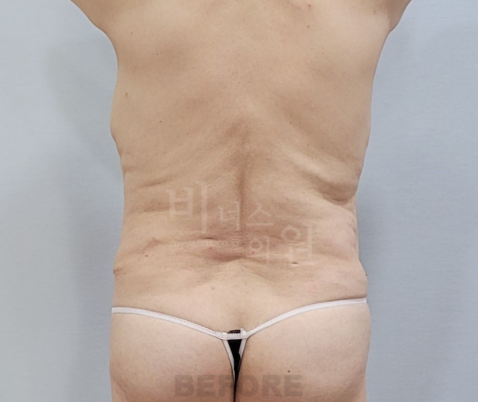 복부 지방흡입 수술 전 후면 사진