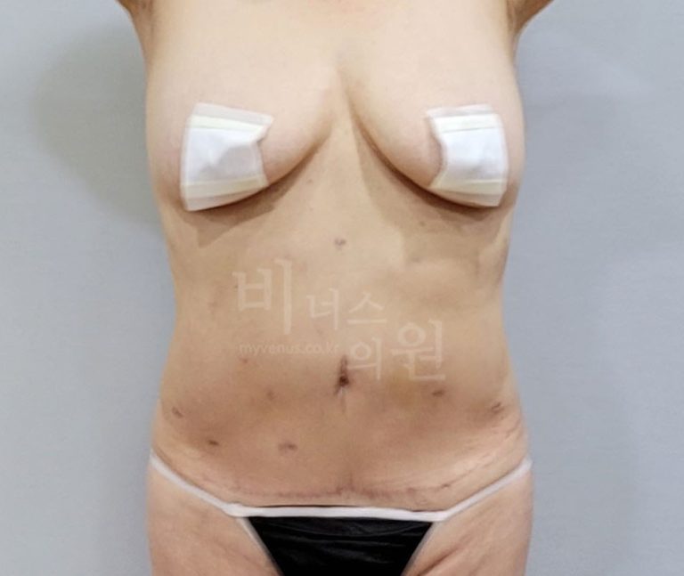 복부 지방흡입 재수술 후 정면 사진
