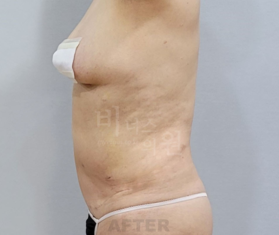 복부 지방흡입 수술 후 측면 사진