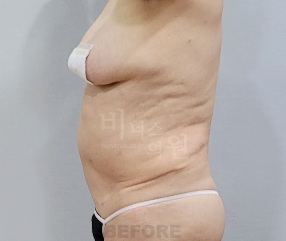 복부 지방흡입 수술 전 측면 사진