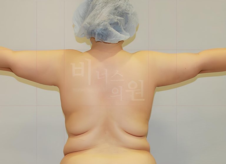 팔뚝지방흡입, 상담 전 가장 많이 묻는 질문 5가지와 오해 바로잡기