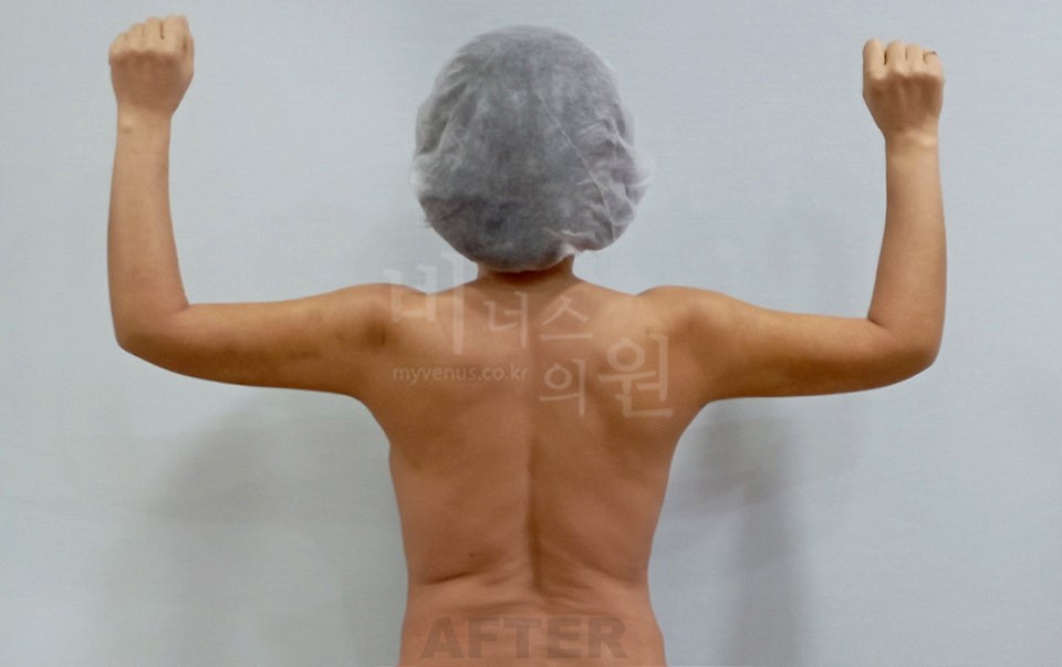 팔뚝지방흡입 수술 후 뒷모습 양팔 위로 든 자세