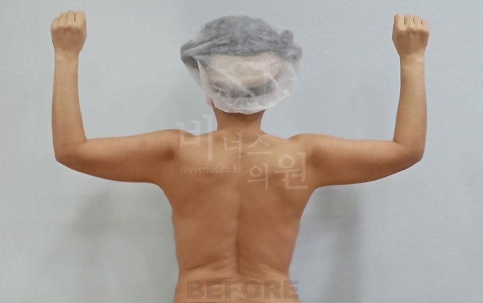 팔뚝지방흡입 수술 전 뒷모습 양팔 위로 든 자세